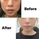 라인소프트 | 청담라인리프팅 소프트웨이브 티타늄리프팅 효과 2개월차 후기