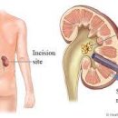 경피 신루 설치술[percutaneous nephrostomy] 이미지