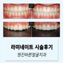 원진치과기공소 | 라미네이트시술후기, 치아삭제량 확인은 필수