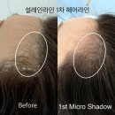 [인천 헤어라인문신] 설레인라인 SMP 헤어라인 문신으로 컴플렉스 극복! 🎀