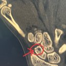 성민병원 | [주상골 골절 후기2] 주상골 골절 수술 병원 고르기(성민병원, 예손병원)