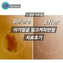 오라클 안경 | 아기 밀크커피반점 치료 6회만에 없어짐 밀크반점
