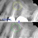 치근단 병소[Periapical lesion] 이미지