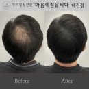 대전두피문신 잘하는곳, 마음에점을찍다에서