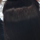 [헤어라인교정후기] 6. 수술 후 2주차 후기