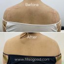 종아리 튼살 없애는 법, 하얀 튼살도 달라질 수 있을까? 필소굿