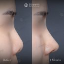 들창코 티스토리