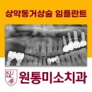 원통미소치과의원 네이버블로그