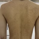 해율한의원 | 등 가슴 여드름 고민 끝! 해율한의원 강남점 치료 후기