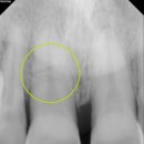 치근 파절[root fracture] 이미지