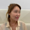 청담공드림피부과의원 | 청담역피부과 청담루틴의원에서 BBL레이저 받은 리얼후기!