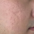 시전 | 오래된 여드름흉터 피부과 여드름흉터 서브시전 3회차 후기