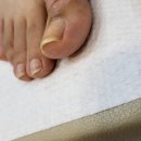 [수원 광교 발관리 /내성발톱]&#34;에스떼K 네일&#34; 내성발톱 시술 후기!!