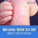 몸이 보내는 '혈관염' 경고 신호, 이건 꼭 알아두세요!" 이미지