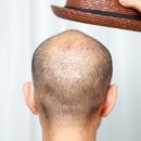 연세코스모의원 | “탈모약, 성기능 저하된다?” 탈모 치료제 부작용, 사실일까? [인터뷰]