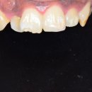 서울아산플란트치과의원 | 수원사랑니, 서울아산플란트치과 함치성낭종 적출 증례