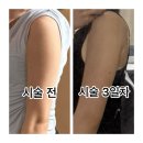 [비스테로이드 지방분해주사] 홍대피부과추천 팔뚝지방분해주사 여름팔라인관리 솔직후기