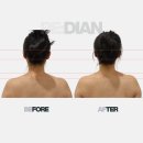 뒷골1 | 10년 두통과 뒷골 당김, 왜 운동, 스트레칭으로는 해결되지 않았을까?