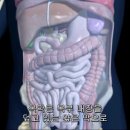 복막암 peritoneal carcinoma 이미지