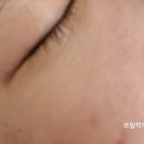 대전피부관리 프롬미 대전점(feat.여드름 예민피부 관리)