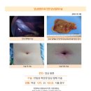 담낭용종수술후. 종합검진 결과 담낭제거 필요하다는 말을 듣고 처음에는 많이 무서웠습니다. 태어나서 수술을 처음... 이미지