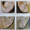 귀 건강학(이혈테라피) 이미지