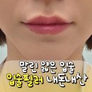 키스 | 입술필러 유명한 곳 강남역 입술필러 레스틸렌키스 내돈내산 후기
