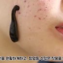 여드름 착색 거머리로 치료하기 이미지