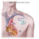 [67] Daily Reading - Pacemaker 이미지