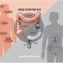 대장암 초기증상 예방 방법 4기 생존율 이미지