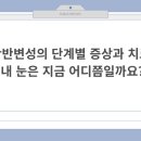 안동더조은안과의원 | 황반변성의 단계별 증상과 치료: 내 눈은 지금 어디쯤일까요?