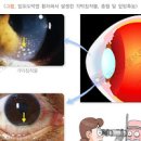 포도막염 증상 및 치료, 홍채염 (시야흐림, 눈부심현상, 안구통증, 오른쪽 왼쪽 눈통증) 이미지