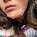 신세계성형외과의원 | 광주 공휴일 얼굴 찢어졌을 때, 미플러스성형외과 턱 봉합수술 후기