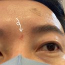 내 돈 내산 리얼 후기, 로담 한의원 잠실점 대상포진 얼굴 상처 치료 피부과 치료, 2회차 치료 진행
