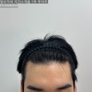 시선을즐기다탈모두피커버헤어라인전문부산점 | 부산 동래 포마드의 완성 - M자헤어라인 두피문신으로 교정한 후기
