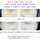 지방이식 사진-눈밑 다크써클,눈밑애교살,눈밑지방 자가지방이식 사진 이미지