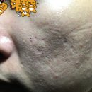 [내돈내산] 사월의봄 한의원 새살침 총 결산 - 여드름 흉터 Before &amp; After 솔직 후기