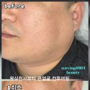 미리내 동성종합상가 | [수원알테온사진후기] 처진 턱살과 각진 하관 고민이라면? 왁싱천사뷰티의 해결법