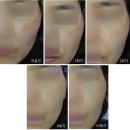 (주)메디피크 | 닥터라이언 기미 피코토닝레이저 치료 과정 4편 (피부과전문의)