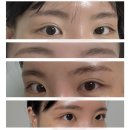 [스테이무아] 인천 눈썹 잔흔제거 후기 인천 아이라인 잔흔제거 잘하는 곳