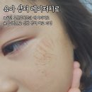 동탄 후즈후피부과 4세 엎어짐으로 인한 얼굴 상처 레이저 치료