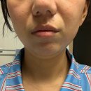 리프테라 쿨페이즈 후기 유어힐의원에서 라인정리 끝