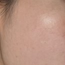 (주)이꼬르 | 기미잡티제거 레이저vs크림 (내돈내산)