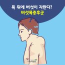 목 뒤에 버섯이 자란다? '버섯목증후군' 이미지