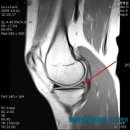 [무릎연골파열] 반월상 연골 파열 관절경수술로 치료하세요~~ 이미지