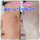 브이 | 천안 남자 모공관리 트라이엄 내돈내산 후기 브이라인 천안점