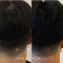 모발 이식을 고민한다면 반드시 알아야 할 것들