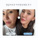 기나건강 | 청담 미라젯 쥬베룩 나비존 전후 비교 통증 내돈내산 솔직 후기