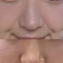 루비약국 | 부산 서면 주근깨 루비레이저 2탄 (1년후기 &amp; 재시술 후기/내돈내산)