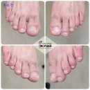 수락산역 4~5번출구 | 노원 통증 없는 무좀관리 전문샵 레푸스 수락산역점 대만족 후기